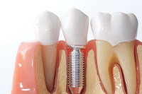 Osseointegration of a dental implant in Collierville, TN