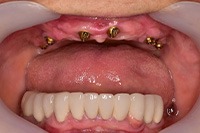 Dental implant placement in Collierville, TN