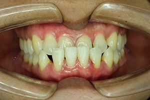 Patient in Collierville with an underbite