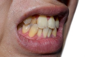 Patient in Collierville with a crossbite